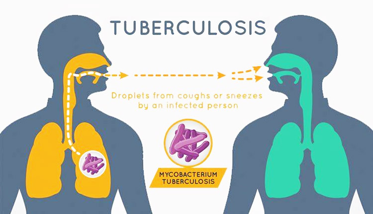 Tuberculosis